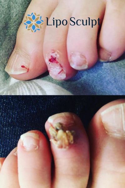 Wart removal customer results from Lipo Sculpt Havering